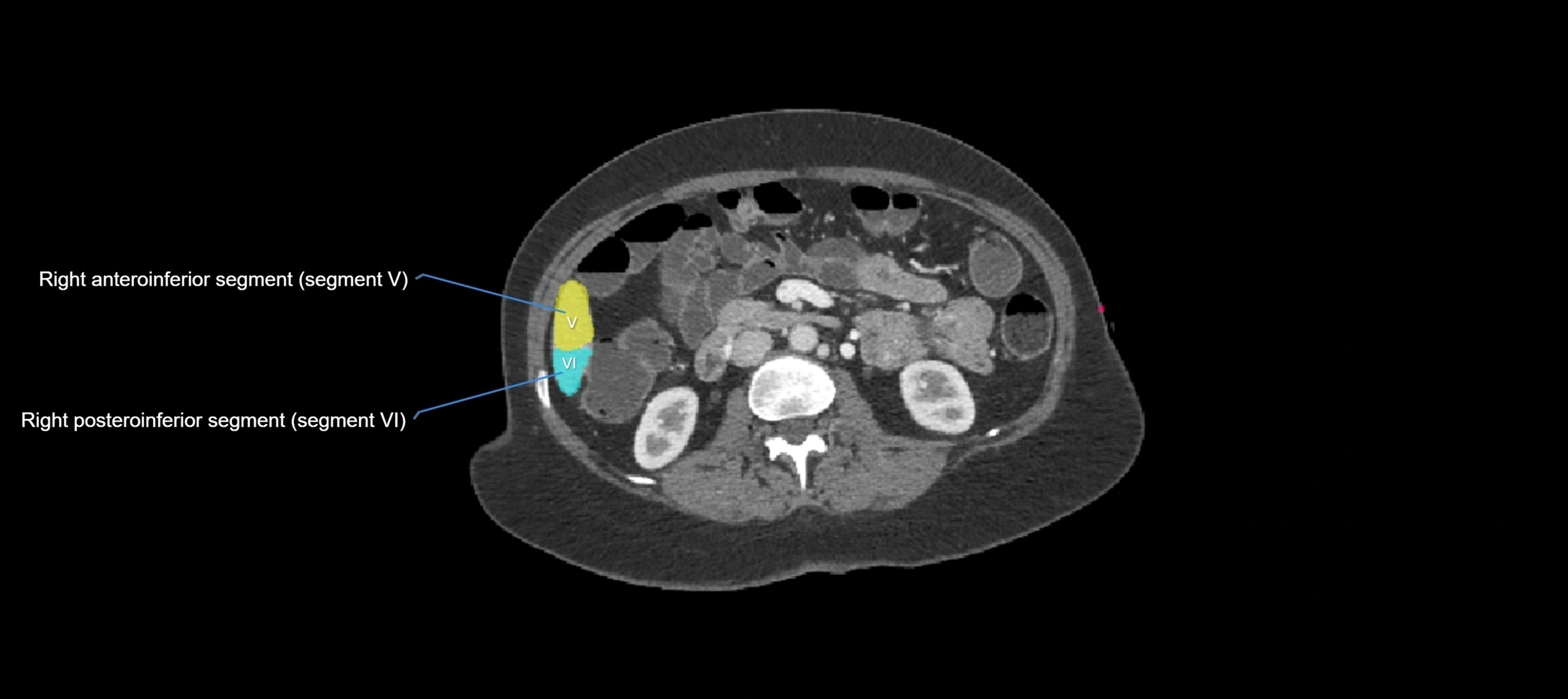 CT liver segments axial cross sectional anatomy labelled image-00009.webp
